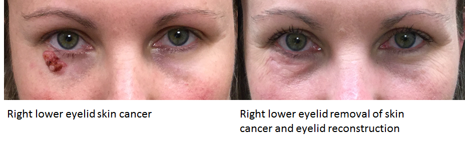 Eyelid Cancer Removal and Reconstruction