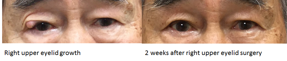 Eyelid lesion/growth removal