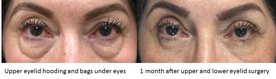 Lower Eyelid Rejuvenation