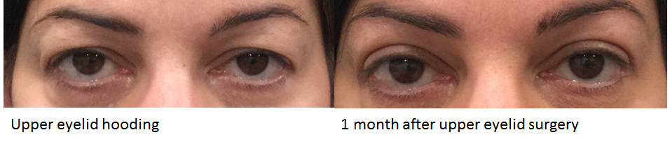 Upper Eyelid Rejuvenation