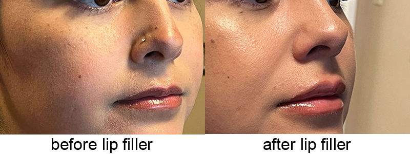 Before After Lip Filler 2