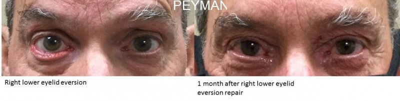 Lower Eyelid Eversion Repair