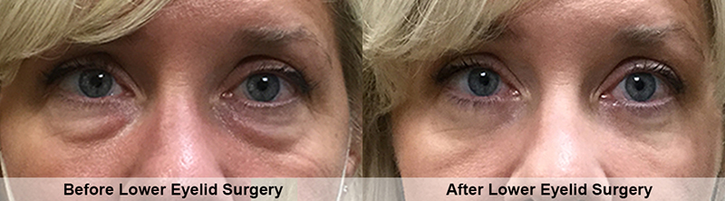 Lower-Eyelid-Testimonial-800-222