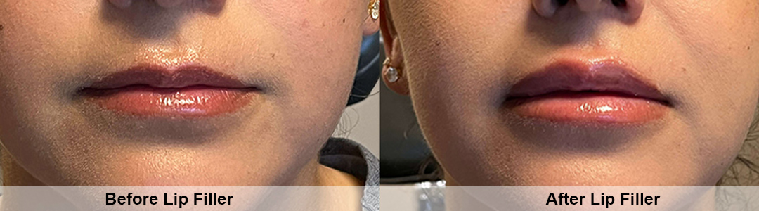 Fresh-Lip-Filler