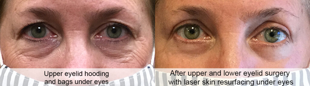 Scarless and Stitchless lower eyelid bag removal 714 449 1940