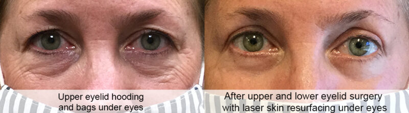 Upper and lower eyelid surgery example