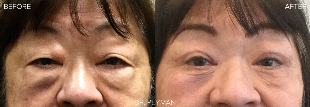 Before and After photos of Asian-Eyelid Surgery