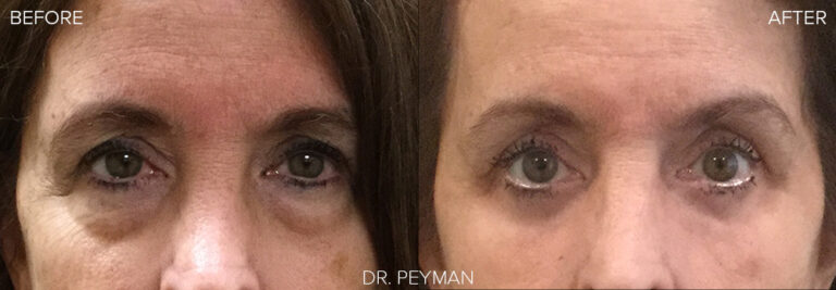 Before & After : Lower eyelid transconjunctival blepharoplasty with laser skin resurfacing under the eyes