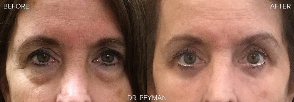 Before & After : Lower eyelid transconjunctival blepharoplasty with laser skin resurfacing under the eyes