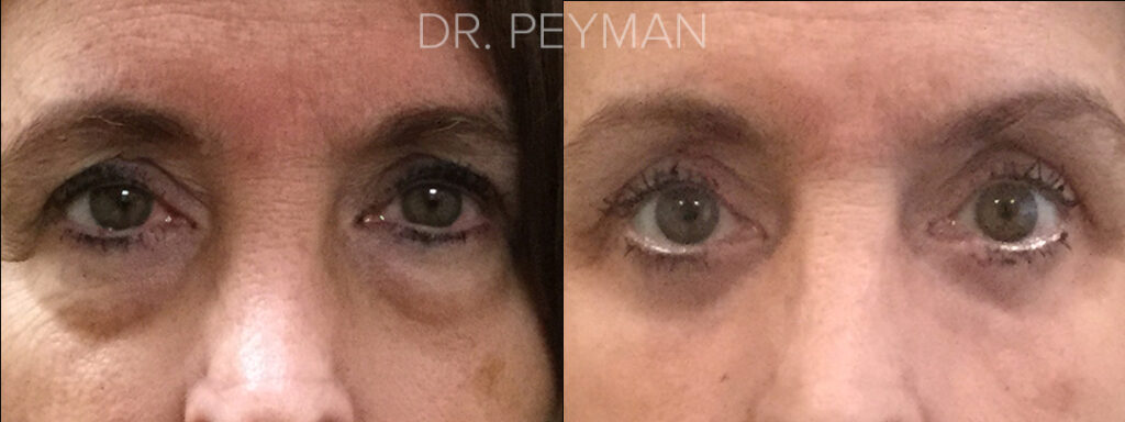 Before & After : Lower eyelid transconjunctival blepharoplasty with laser skin resurfacing under the eyes