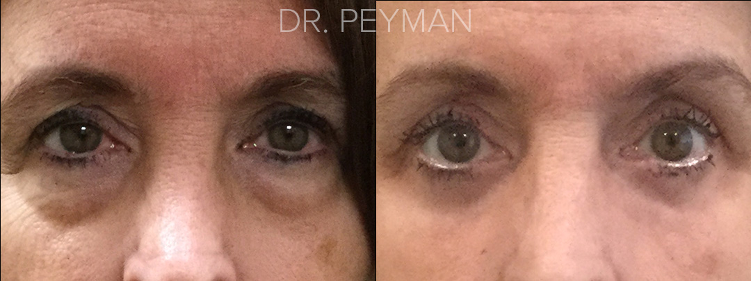 Before & After : Lower eyelid transconjunctival blepharoplasty with laser skin resurfacing under the eyes
