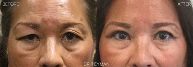 before and after photo of oculoplasty surgery and or ptosis repair
