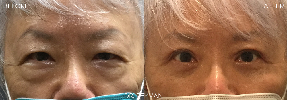 before and after Upper and lower eyelid blepharoplasty