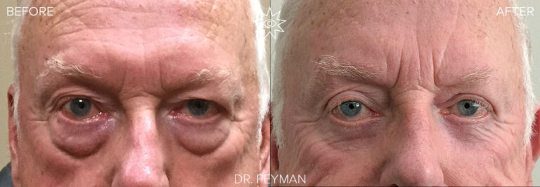 Before and After upper and lower eyelid blepharoplasty