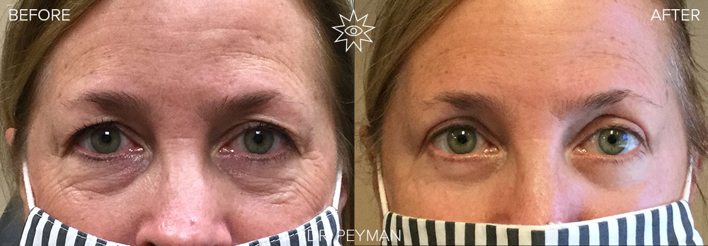 Before and After Scarless Lower Eyelid Surgery & Laser Resurfacing