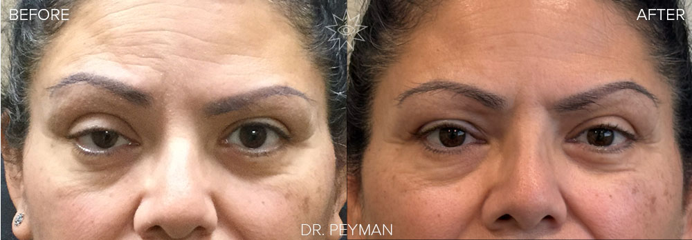 before and after photo of a female with ptosis surgery. creating balance