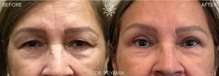 Before and After - upper blepharoplasty eyelid rejuvenation