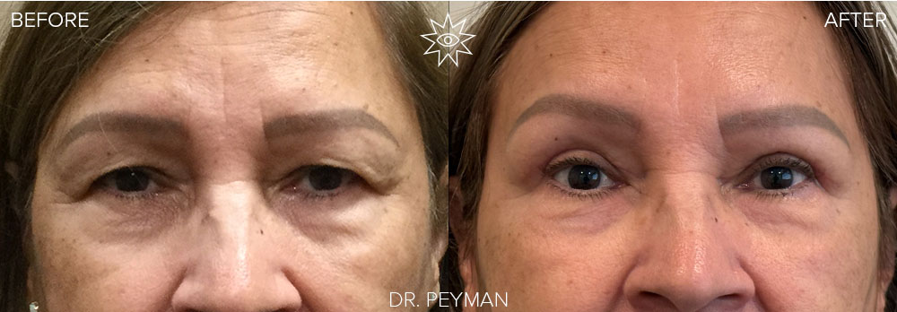 Before and After - upper blepharoplasty eyelid rejuvenation