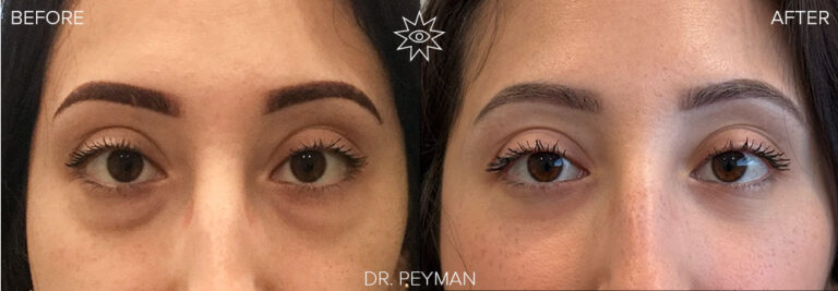 Before and after lower blepharoplasty