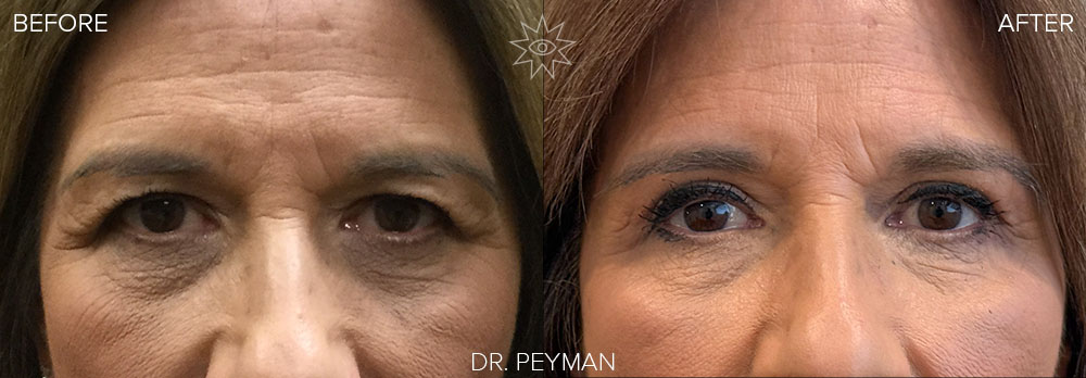 understanding-your-eyelid-rejuvenation-options