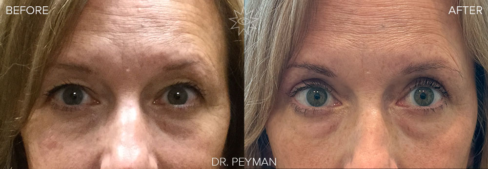 a before and after photo of a upper blepharoplasty can brighten up your eyes.