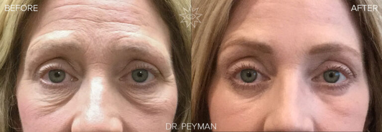 Before and After photo of CO2 Laser Resurfacing result