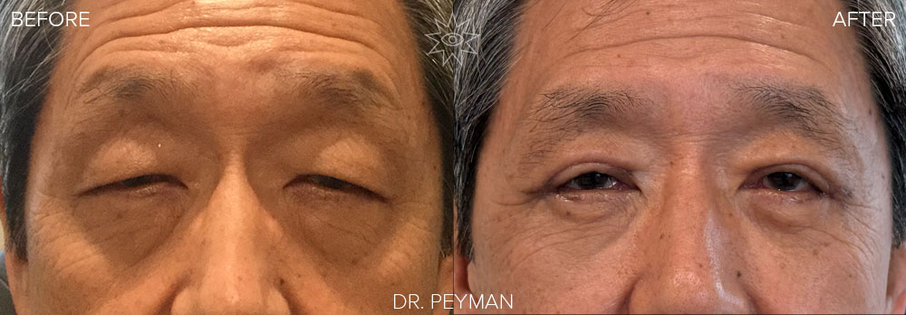 before and after upper and lower eyelid blepharoplasty, crease formation