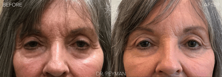 before and after photo of a female with ptosis repair