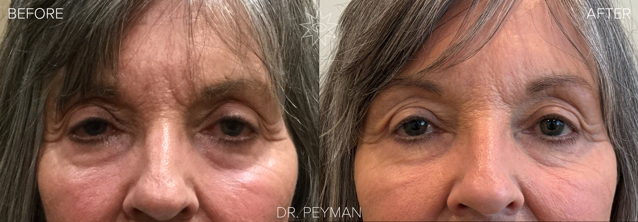 before and after photo of a female with ptosis repair