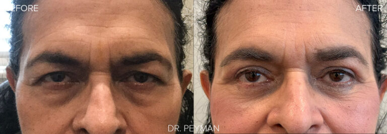 before and after photo of quad blepharoplasty