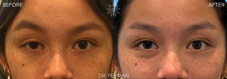 before and after Achieving Natural Symmetry: The Art of Internal Ptosis Repair
