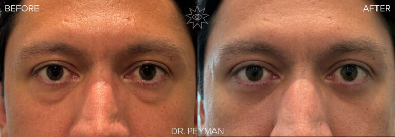 before and after photos with only 1 week after surgery