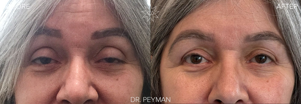 This patient’s drooping eyelid (ptosis) was affecting her sight. Dr. Sabet-Peyman performed a ptosis repair to lift the eyelid back to its natural position.