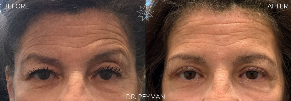 before and after upper bleph with eyebrow botox