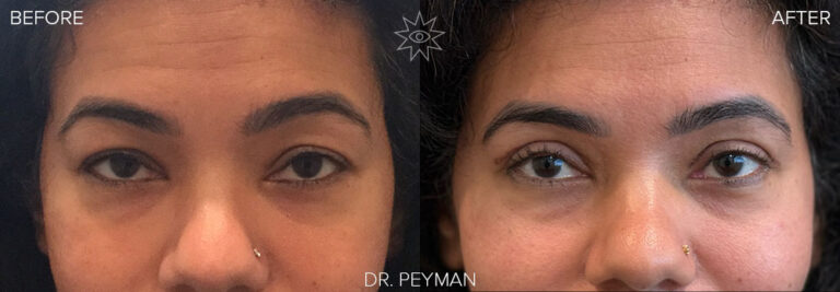 before and after photo of upper blepharoplasty