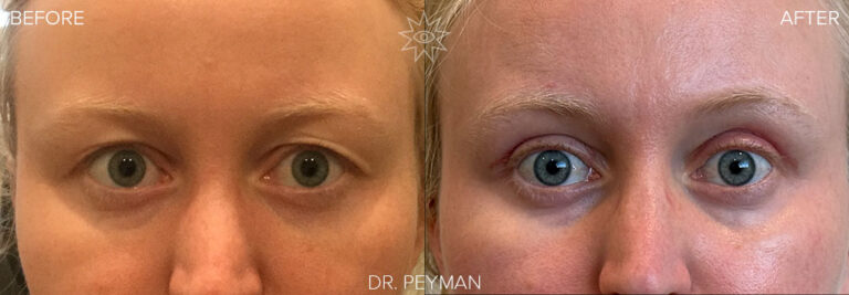 Before and After photo of upper blepharoplasty