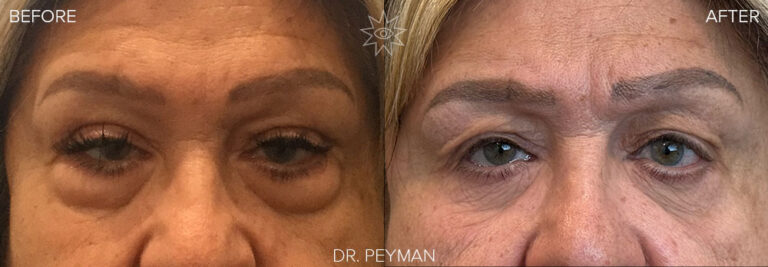 Before and after photo of upper eyelid ptosis repair and scarless lower blepharoplasty in Orange County. Performed by Dr. Jason Sabet-Peyman, the image shows the patient’s transformation from tired, droopy eyelids and under-eye bags to open, alert, and rejuvenated eyes.