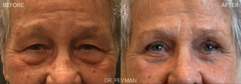 blepharoplasty-laser-resurfacing-orange-county