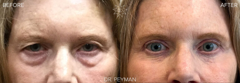 Before-and-after image taken years apart, showing the lasting results of a quad blepharoplasty with laser resurfacing by Dr. Sabet-Peyman in Orange County. The patient’s transformation from hooded, tired eyes and under-eye bags to a smooth, youthful, and alert appearance is maintained years later. Front view.