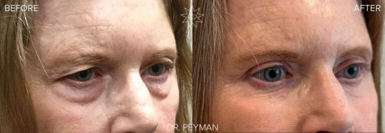 Before-and-after image taken years apart, showing the lasting results of a quad blepharoplasty with laser resurfacing by Dr. Sabet-Peyman in Orange County. The patient’s transformation from hooded, tired eyes and under-eye bags to a smooth, youthful, and alert appearance is maintained years later.