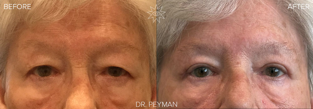 Before and after of an upper eyelid blepharoplasty by Dr. Sabet-Peyman in Orange County, showing a dramatic lift of hooded, heavy eyelids for a brighter, more alert, and youthful appearance.