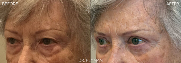 Before and after photo of an 85-year-old patient who received a quad blepharoplasty in-office by Dr. Jason Sabet-Peyman in Orange County. The image shows a remarkable transformation from tired, heavy eyelids and bags to a bright, alert, and significantly more youthful appearance.