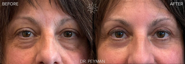 Before and after of a woman's full eye rejuvenation with quad blepharoplasty and laser resurfacing by Dr. Jason Sabet-Peyman in Orange County, showing a transformation to a balanced, youthful, and naturally refreshed appearance.