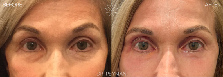 Before and after of a transconjunctival lower eyelid blepharoplasty with periocular laser by Dr. Sabet-Peyman in Orange County, showing a subtle but significant smoothing of the under-eye contour for a refreshed and natural result.