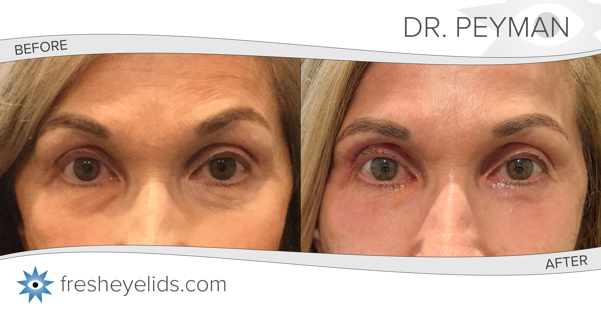 The Power of Precision: How a Subtle Contour Change Makes a Huge ...