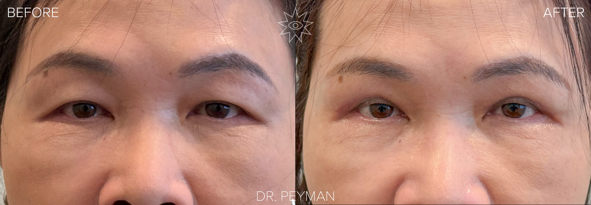 Before and after of an Asian patient's upper eyelid blepharoplasty by Dr. Sabet-Peyman in Orange County, showing the lifting of heavy, hooded eyelids to create brighter, more open, and rejuvenated eyes.
