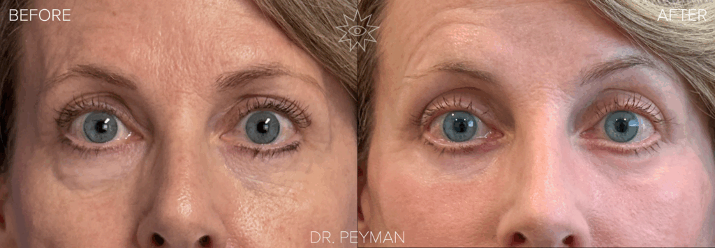 Before and after of a revision lower blepharoplasty with laser resurfacing by Dr. Jason Sabet-Peyman in Orange County, showing the correction of unevenness from a previous surgery for a smooth, balanced, and natural result.