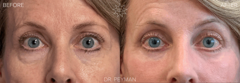 Before and after of a revision lower blepharoplasty with laser resurfacing by Dr. Jason Sabet-Peyman in Orange County, showing the correction of unevenness from a previous surgery for a smooth, balanced, and natural result.