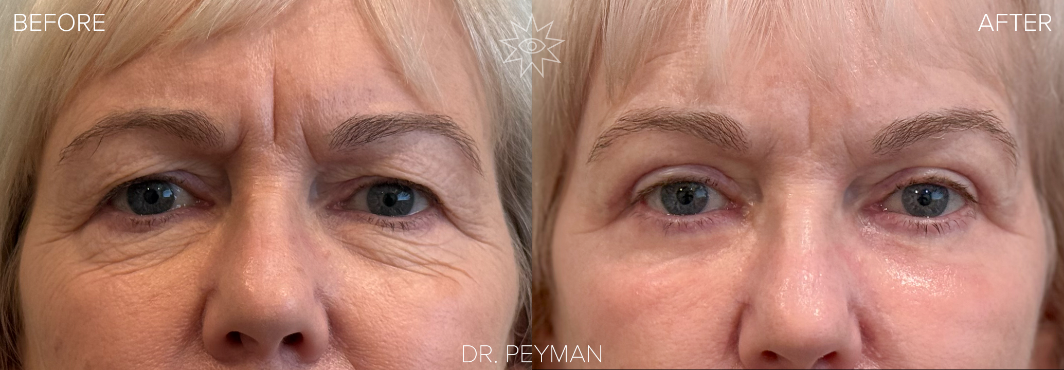 Before and after of a woman's natural eye rejuvenation with quad blepharoplasty and laser resurfacing by Dr. Sabet-Peyman in Orange County, showing a subtle but significant refresh of the eyes.