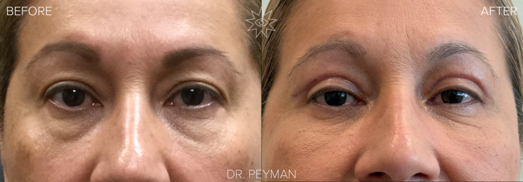 Before and after of a female patient’s quad blepharoplasty by Dr. Jason Sabet-Peyman in Orange County. The image demonstrates the restoration of the "eyelid platform"—the visible space above the lashes—creating a brighter, more open appearance.